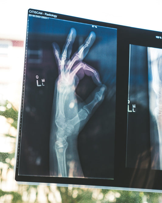 Exploring the Link Between Osteoporosis and Environmental Toxins