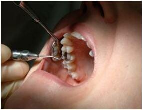 Silver Dental Fillings Can Ruin Your Health